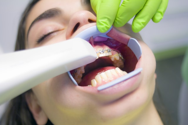prostowanie zębów nakładkami - jak działają nakładki na zęby prostujące. Jak wygląda planu leczenia, jak często pacjent powinien przychodzić na wizyty kontrolne.